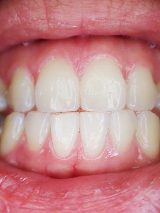gingivitis dui